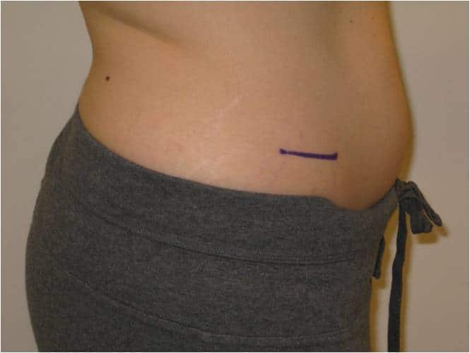 Cost of Coolsculpting in Baltimore, MD by Dr. Jeffrey Schreiber