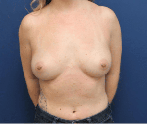 breast augmentation baltimore