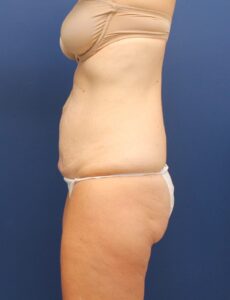NEW 50 year old female Tummy tuck_S1