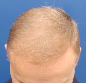 NEW 53-Year-Old _ FUE hair transplant 2_F2