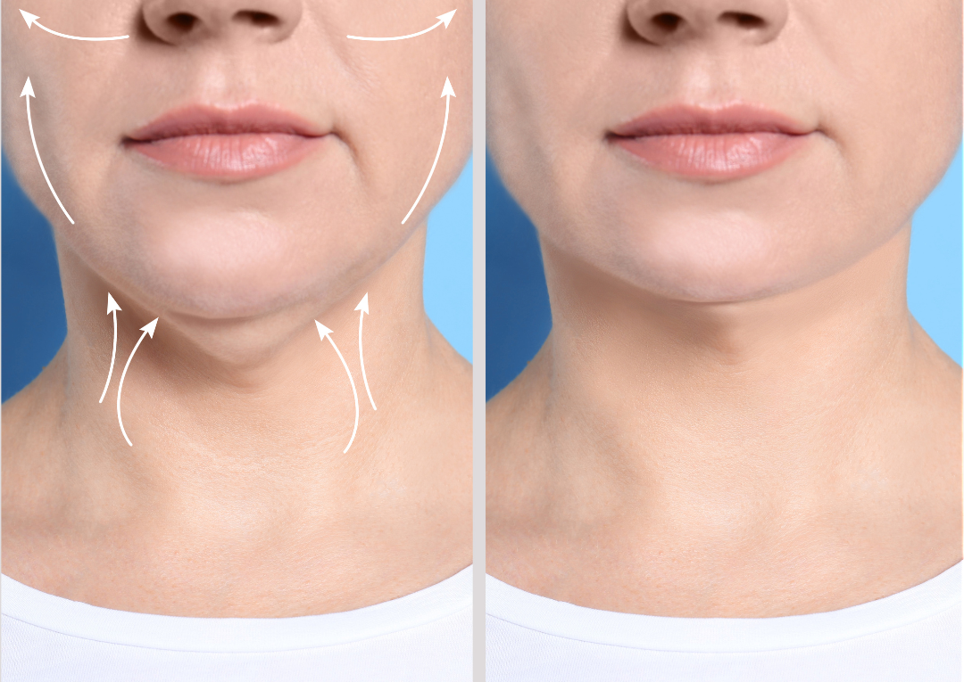 surgical facial rejuvenation