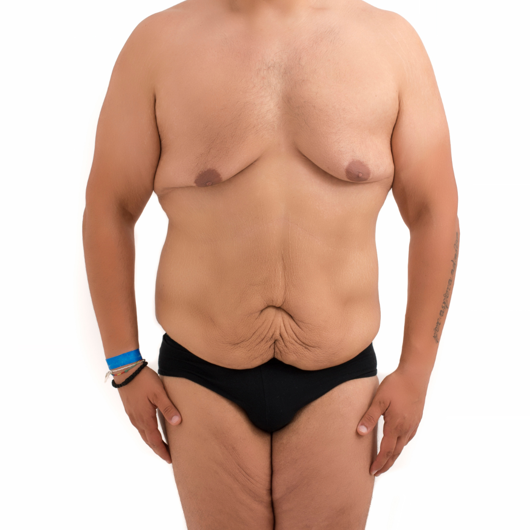 body lift in Baltimore